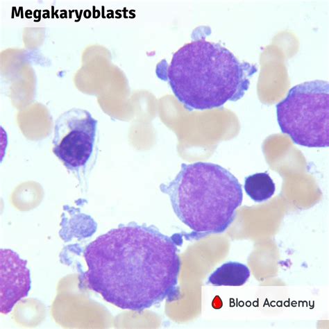 Megakaryoblast .